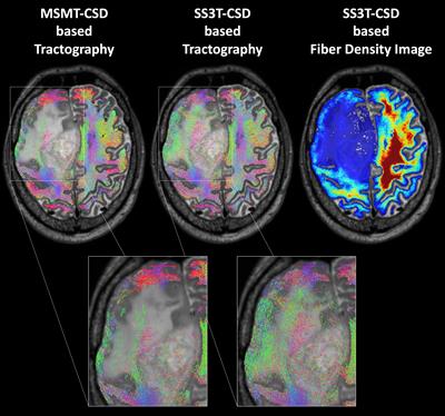 Alterations in white matter fiber density associated with structural MRI and metabolic PET lesions following multimodal therapy in glioma patients